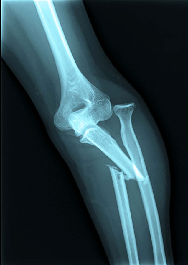 fractura-luxacion-de-huesos-Calcibone